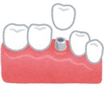 teeth_implant